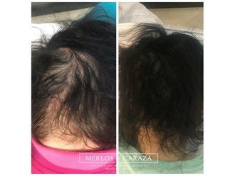 Trasplante de cabello - 645541