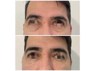 Blefaroplastia