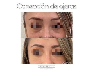 Corrección de ojeras - Merlos & Caraza