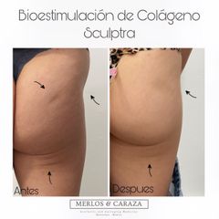 Gluteoplastia - Merlos & Caraza