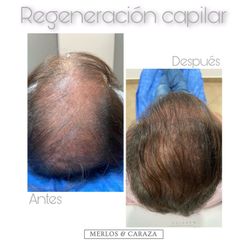 Alopecia - Merlos & Caraza