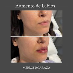 Aumento de labios - Merlos & Caraza
