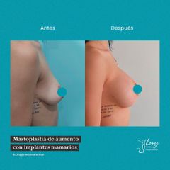 Aumento de busto - Dr. Jhony Camarero