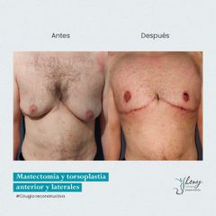 Mastectomia - Dr. Jhony Camarero