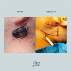 Cirugía reconstructiva - Dr. Jhony Camarero