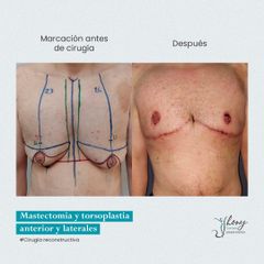 Mastectomia - Dr. Jhony Camarero