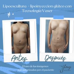 Lipoescultura - Dr. Jhony Camarero