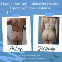 Liposucción - Dr. Jhony Camarero