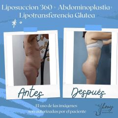Liposucción - Dr. Jhony Camarero