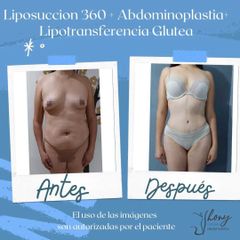 Liposucción - Dr. Jhony Camarero