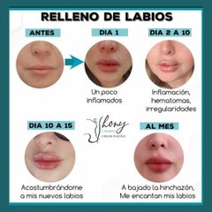 Aumento de labios - Dr. Jhony Camarero