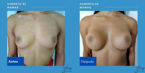 Aumento de busto - Dr. Jhony Camarero