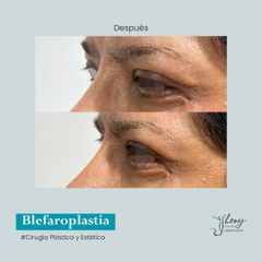 Blefaroplastia - Dr. Jhony Camarero