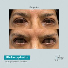 Blefaroplastia - Dr. Jhony Camarero