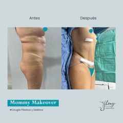 Mommy makeover - Dr. Jhony Camarero