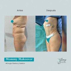 Mommy makeover - Dr. Jhony Camarero