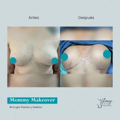 Mommy makeover - Dr. Jhony Camarero