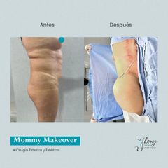 Mommy makeover - Dr. Jhony Camarero