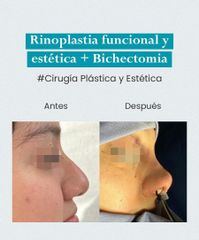 Rinoplastia - Dr. Jhony Camarero