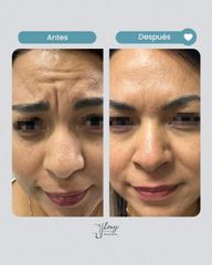 Toxina Botulínica - Dr. Jhony Camarero