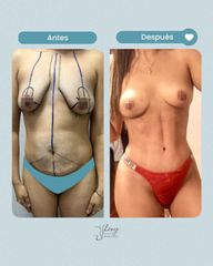Lipoescultura - Dr. Jhony Camarero