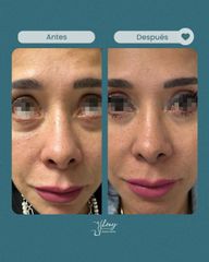 Eliminar ojeras - Dr. Jhony Camarero