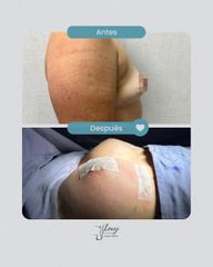 Mastopexia con aumento - Dr. Jhony Camarero