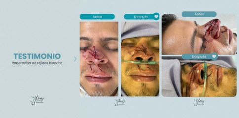 Cirugía plástica reconstructiva - Dr. Jhony Camarero