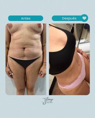 Abdominoplastia - Dr. Jhony Camarero