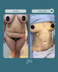 Abdominoplastia - Dr. Jhony Camarero