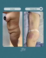 Abdominoplastia - Dr. Jhony Camarero