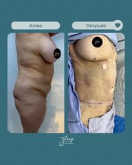 Abdominoplastia - Dr. Jhony Camarero