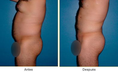 Antes y después de Liposucción