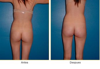 Antes y después de Gluteoplastia