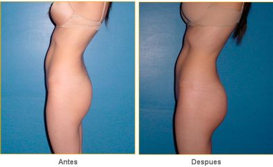 Antes y después de Gluteoplastia