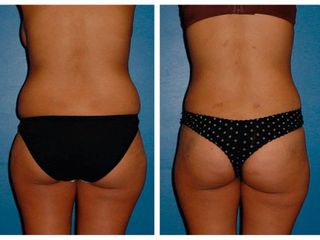 Antes y después de Liposucción