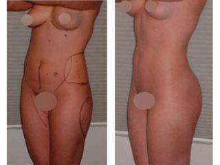 Antes y después de Lipoescultura