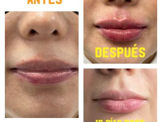 Aumento de labios - 820317