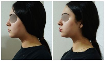 Aumento de labios - Dra. Laura Barrera Martínez