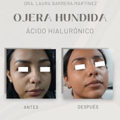 Ácido hialurónico - Dra. Laura Barrera Martínez