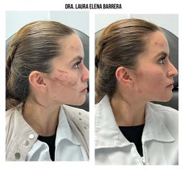 Rejuvenecimiento Facial - Dra. Laura Barrera Martínez