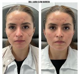 Rejuvenecimiento facial - Dra. Laura Barrera Martínez