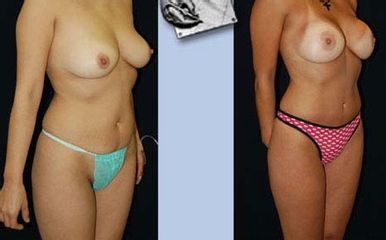 Antes y después de mastopexia