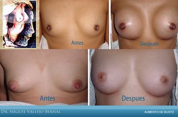 Antes y después de Aumento de busto