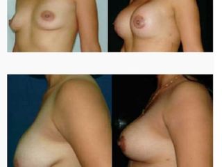 Antes y después de mastopexia