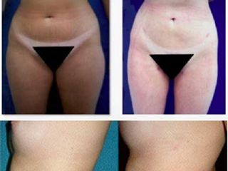 Antes y después de lipoescultura
