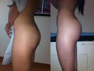 Antes y después de levantamiento de gluteos