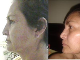 Lipotransferencia rejuvenecimiento facial.