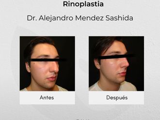 Rinoplastia antes y después - 840758