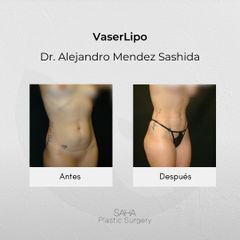 Liposucción - Dr. Alejandro Méndez Sashida